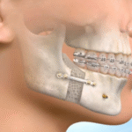 Understanding Jaw Surgery: What It Is and Why It’s Done
